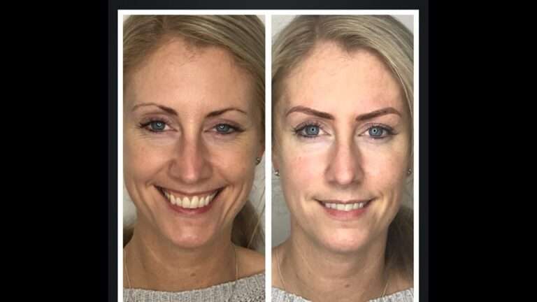 Semi-permanent brows before and after – Skinful Aesthetics, Great Yarmouth