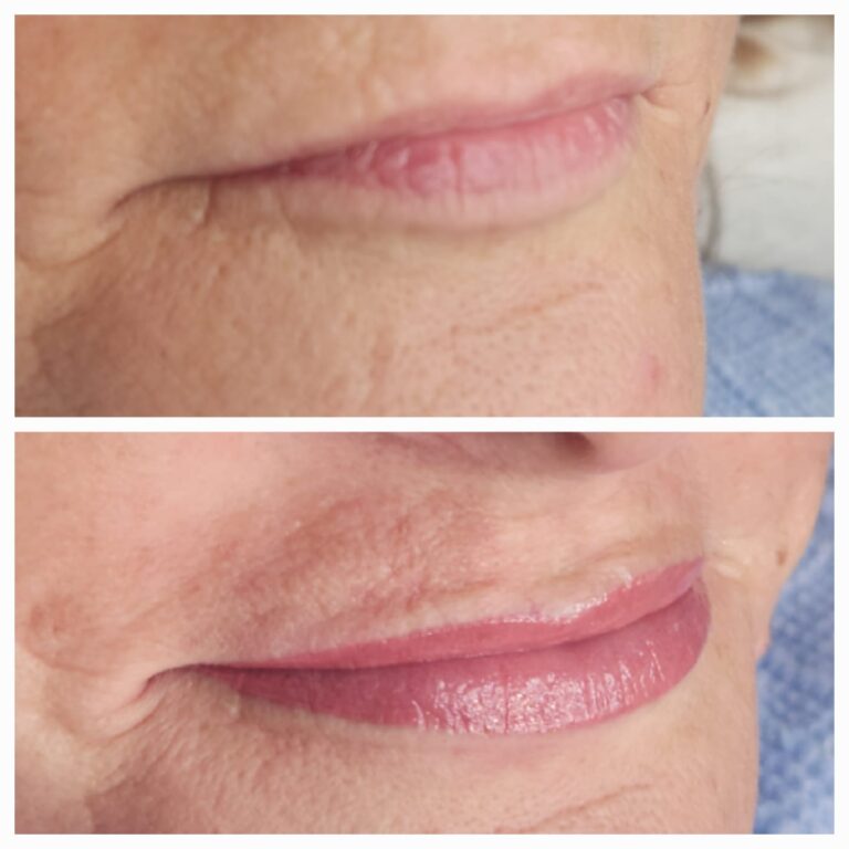 Semi-permanent lips before and after – Skinful Aesthetics, Great Yarmouth